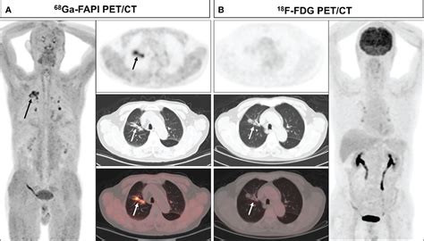 Frontiers Comparison Of 68ga Fapi And 18f Fdg Petct In The