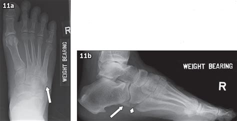 Common Accessory Ossicles Of The Foot Imaging Features Pitfalls And