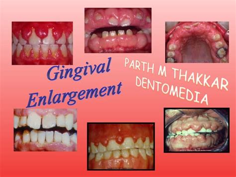 Gingival Swellings Differential Diagnosis