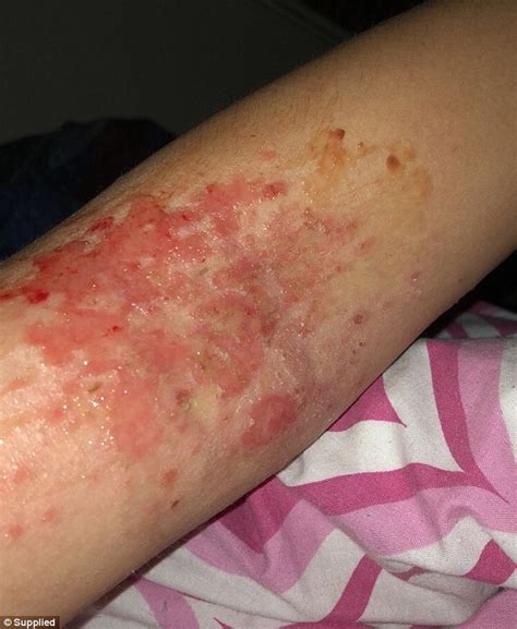 Perth Girl Bullied Because Of Her Eczema Can Now Wear Shorts Daily