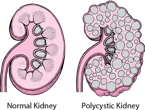 Quick Facts Polycystic Kidney Disease Pkd Merck Manuals Consumer