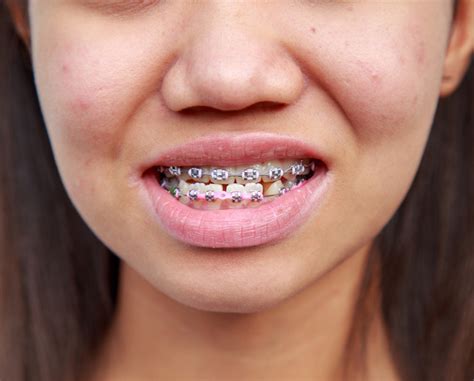 Maybe you would like to learn more about one of these? Six Signs you May Need Adult Braces - Reproductive Healths