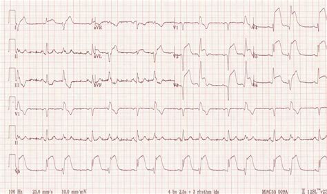 Electrocardiogram In Myocardial Infarction