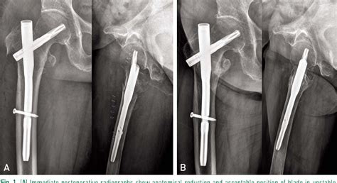 Figure 1 From Fixation Failure Of Proximal Femoral Nail Anti Rotation