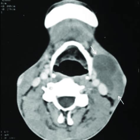 Beak Sign In Second Branchial Cleft Cyst Contrast Enhanced Ct Image