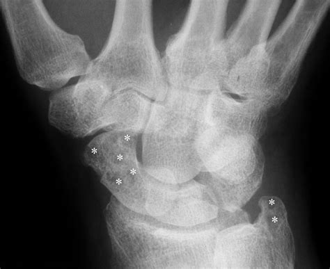Ra Of The Wrist Radiograph Detail View Shows A Ballooned Ulnar