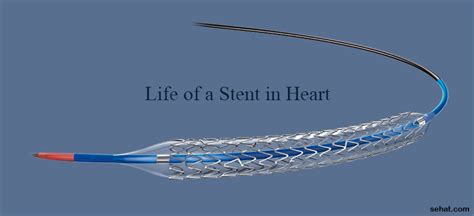 How Long Does A Heart Stent Last Healthy Living