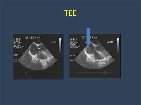 Amazon second chance pass it on, trade it in, give it a second life. PPT - Venous air embolism (VAE) PowerPoint Presentation ...