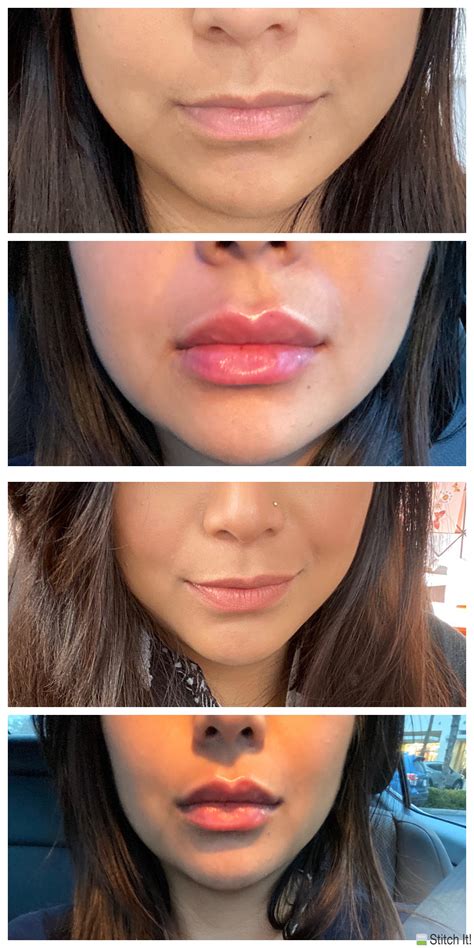 Thin Juvederm Lips Before And After 1 Syringe Nojus Britton