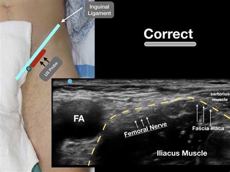 Femora Nerve Block — Highland Em Ultrasound Fueled Pain Management