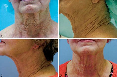 A Preoperative Patient Age Neck Peel Frontal View Using