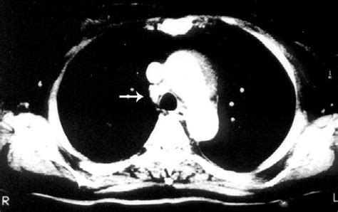 Chest Computed Tomography Revealed Paratracheal Lymphadenopathy Arrow