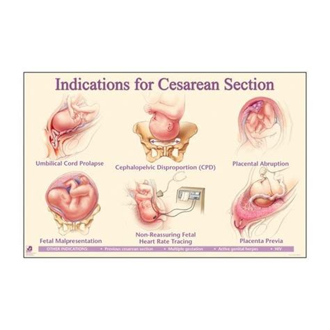 Indications For Cesarean Section Wall Chart Child Nursing Newborn
