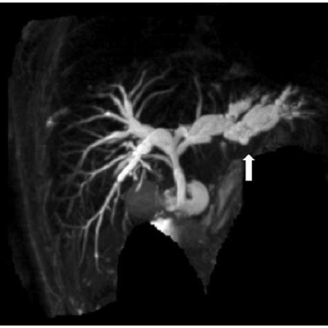 A Coronal Mrcp Image Demonstrating The Dilated Intrahepatic Biliary