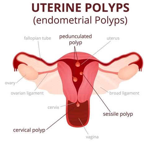 Uterine Polyps Causes Symptoms And Treatment