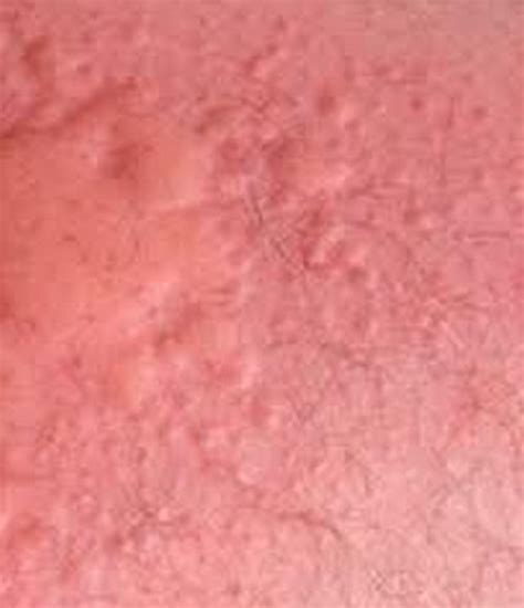 Chlorine Rash Allergy Pictures Treatment Home Remedies Prevention
