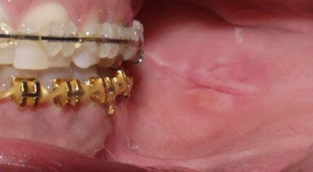 It may be a lot more harmful. Emergencies - Orthosmile Orthodontics
