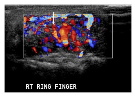 Synovial Sarcoma Mri Of The Same Patient As Figure 8 On T2w Images