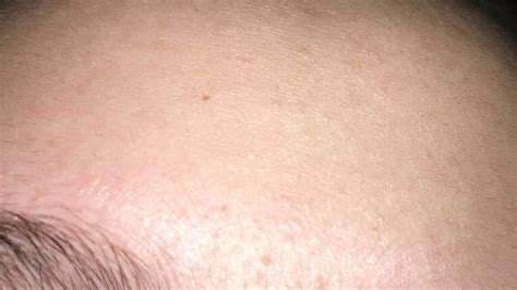 Skin Colored Bumps On Cheeks And Forehead General Acne Discussion