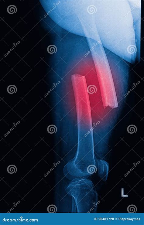 Broken Human Thigh X Rays Image Stock Photo Image Of Imaging Ache