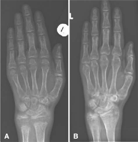X Ray Of The Hand And Wrist At Time Of Presentation