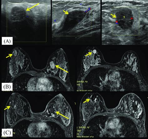 A 23 Year Old Woman With Bilateral Breast Fibroadenomas A Ultrasound