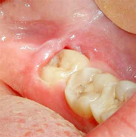 Dor No Dente Do Siso Pode Ser Pericoronarite Diagnóstico Sintomas