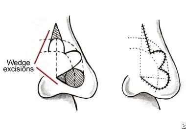 Principles And Techniques Of Nasal Reconstruction Overview