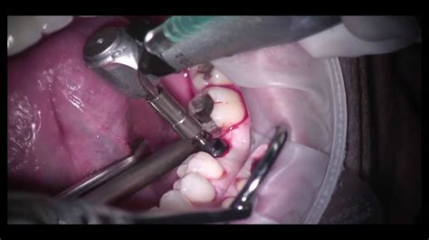 Guided Dental Implant Surgery Part Youtube