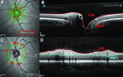 Spectral Domain Optical Coherence Tomography Imaging And Parameters
