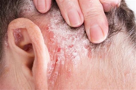 Scaly Or Flaky Skin Causes Symptoms And Treatment Bodewell