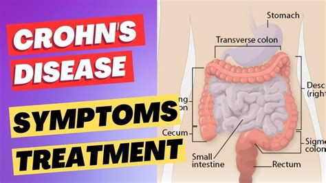 Crohns Disease Symptoms Diagnosis And Treatment Youtube