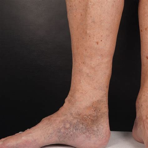 The Skin Is Affected By Bad Leg Veins The Veincare Centre