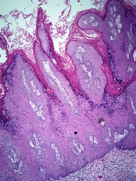 Verrucous Hyperplasia Showing Epithelial Dysplasia Hematoxylin And