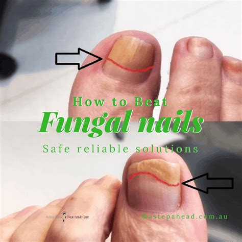 How Tanya Beat Unsightly Nail Fungus A Step Ahead Foot And Ankle Care