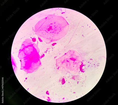 Prostatic Smear For Gram Staining Microscopic X Show Neisseria Gonorrhoeae Bacteria