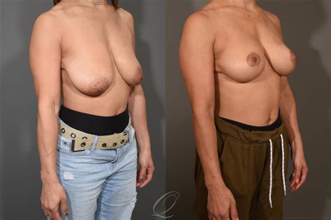 Breast Lift Before After Photos Patient 386 Serving Rochester