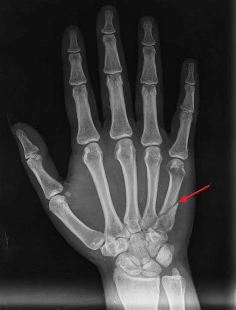 Metacarpal Fracture Causes Symptoms Diagnosis And Treatment