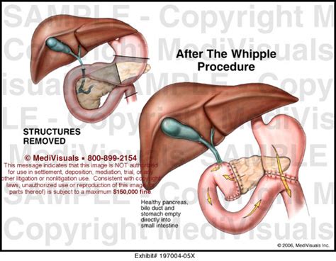 Whipple Procedure Animation