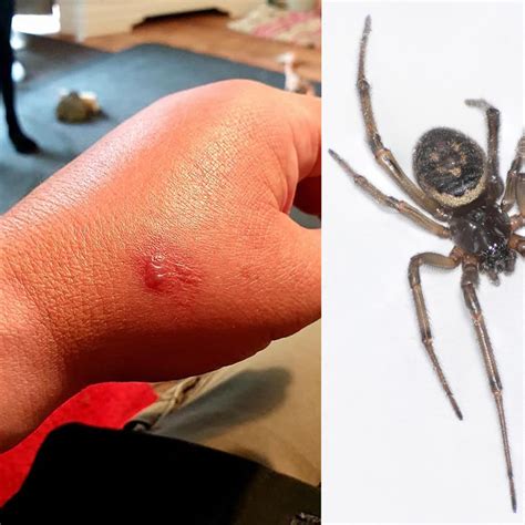 Black Widow Spider Bite Images