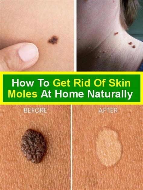 Naturally At Home You Can Get Rid Of Skin Moles Skin Moles How To