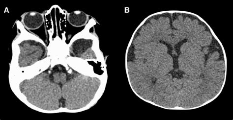 Ct Scan Of A 9 Month Old Child Demonstrating A 25 · 15 Cm Arachnoid