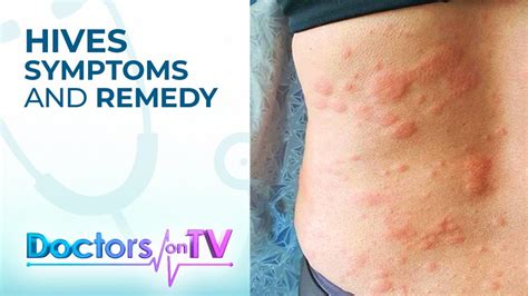 Hives Symptoms And Remedy Dotv Youtube