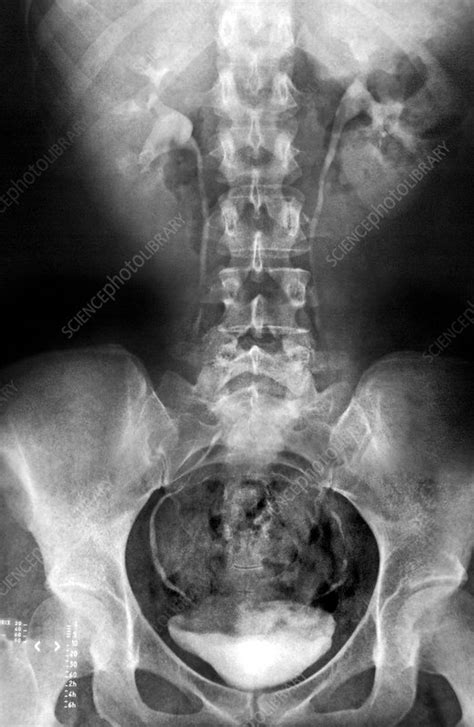 Spine And Pelvis X Ray Stock Image C0021303 Science Photo Library