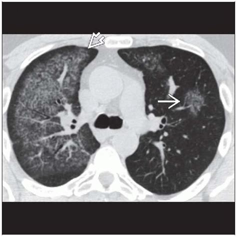 Diffuse Alveolar Hemorrhage CT Scan