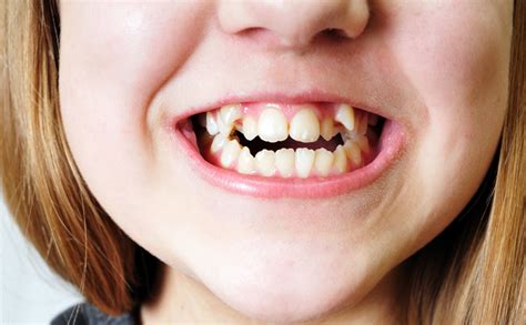 Crooked Teeth Causes And Solutions Medical Bulletin
