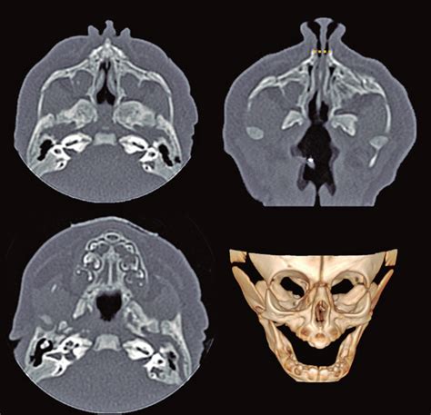 Axial Computed Tomography Scan Sections Of Paranasal Sinuses A Open
