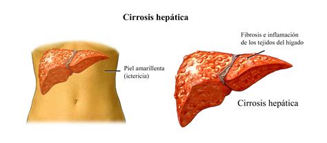 CIRROSIS HEPATICA CAUSAS Y SINTOMAS Cirrosis hepática Cirrosis Causas