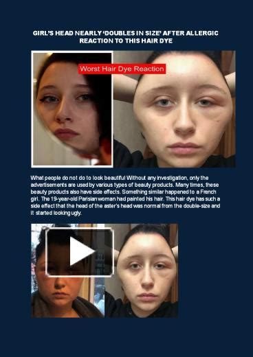 Ppt Girl’s Head Nearly ‘doubles In Size’ After Allergic Reaction To This Hair Dye Powerpoint