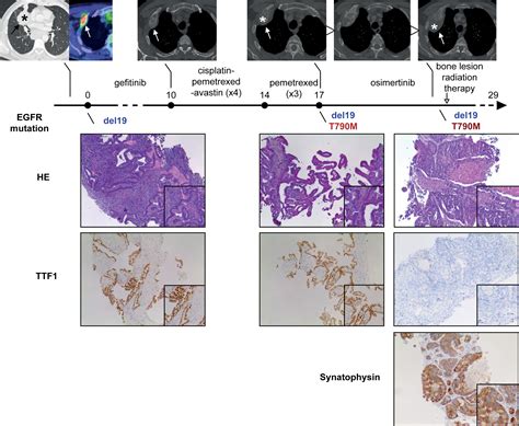 Large Cell Neuroendocrine Lung Carcinoma Transformation As An Acquired